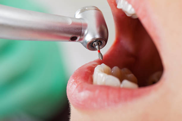 Best Emergency Root Canal Treatment in Reynoldsville, PA
